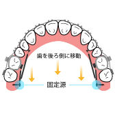 奥歯の後方移動